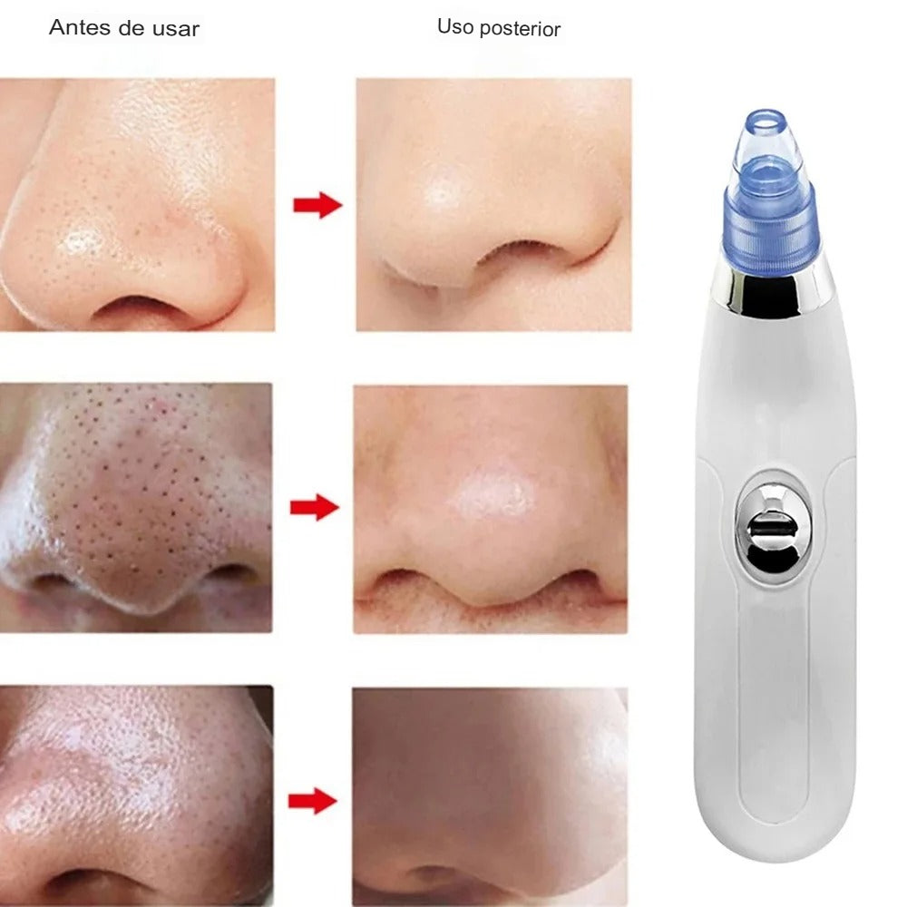 ✨ Removedor Eléctrico de Comedones por Succión a Vacío – Tu spa facial en casa ✨
