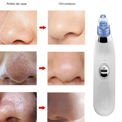 ✨ Removedor Eléctrico de Comedones por Succión a Vacío – Tu spa facial en casa ✨